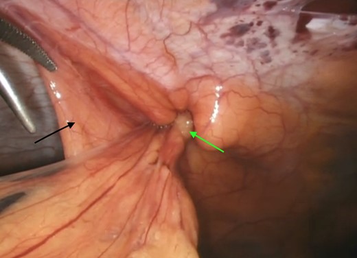 Incarcerated omentum (green arrow) within the falciform ligament (black arrow).