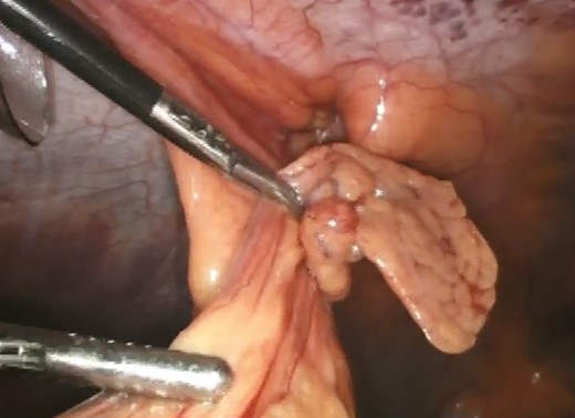 Release of the viable incarcerated omentum.