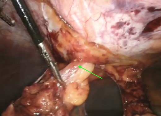 Reduction of falciform ligament hernia (green arrow).