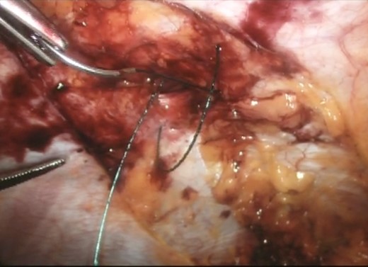 Laparoscopic intra-corporeal suturing of hernia neck with V-loc™ suture.