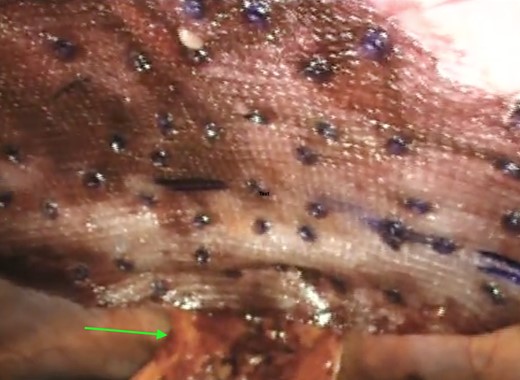 Underlay mesh secured with Absorbatack™ tacks and the mobilized falciform ligament (green arrow).