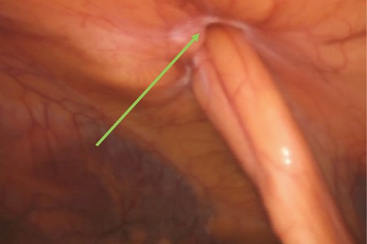 Case 2: Falciform ligament port site hernia (green arrow).