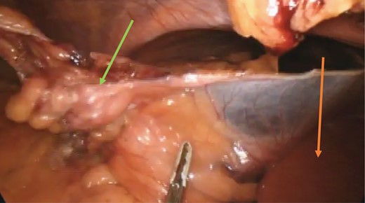 Reduced falciform ligament hernia (green arrow) and left lobe of the liver (orange arrow).