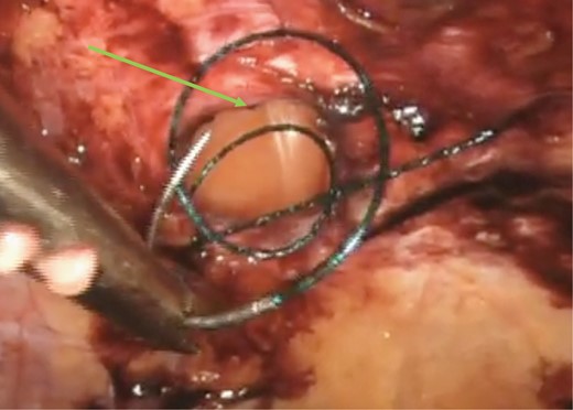 Intra-corporeal suturing of the hernia neck (green arrow) with a V-loc™ suture.