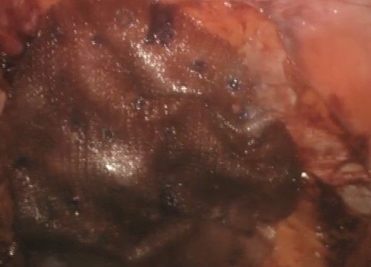 Application of the underlay dual layer Ventralite™ mesh after closure of the hernia neck.