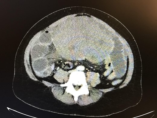 CT abdomen/pelvis showing large intra-abdominal mass causing high-grade small bowel obstruction.