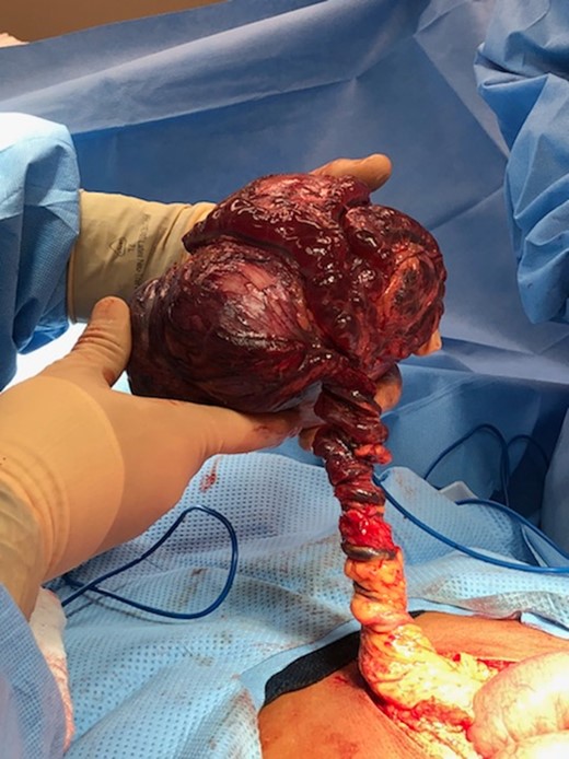 Parasitic leiomyoma with its blood supply arising from the greater omentum.