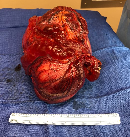 Resected parasitic leiomyoma along with its vascular pedicle.