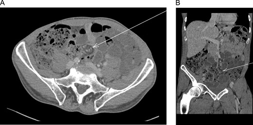(A) Abdominal computed tomography (axial) revealed dilation of small intestine with a rotation of the mesentery around the mesenteric vessels (whirl sign) (arrow). (B) Abdominal computed tomography (coronal) revealed dilation of small intestine with a rotation of the mesentery around the mesenteric vessels (whirl sign) (arrow).