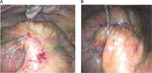 (A) Laparoscopic exploration revealed to barbed suture exposed from the peritoneum and wrapped in mesentery. (B) Laparoscopic exploration revealed to small intestine volvulus.