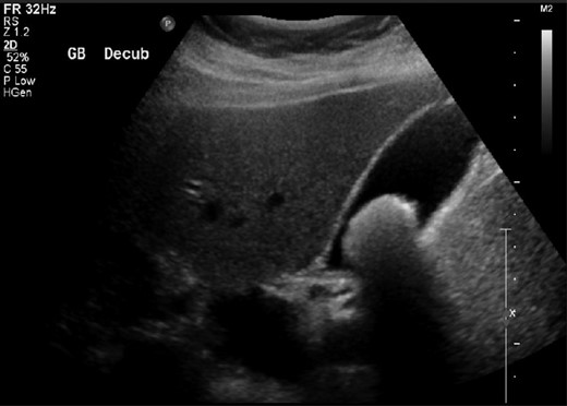 Abdominal US scan demonstrating a large gallbladder stone.