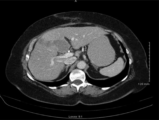 Abdominal CT scan demonstrating metastasis to medial segment of left hepatic lobe.