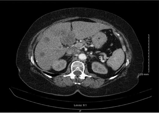 Re-staging abdominal CT scan demonstrating progression of the disease.