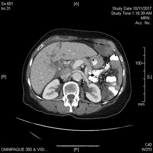 CT imaging of gallbladder lesion with liver metastases.