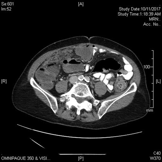 CT imaging identifying extensive peritoneal metastases.