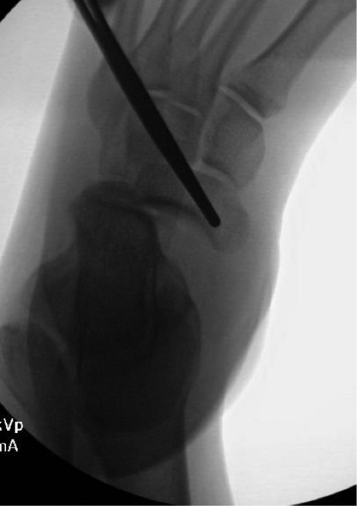 Intraoperative AP view localizing the medial subtalar dislocation.