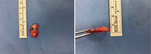 Anteromedial talar head fragment.