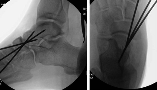 Intraoperative fluoroscopy status-postreduction and fixation.