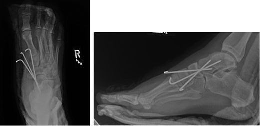 Two-week postoperative plain films.