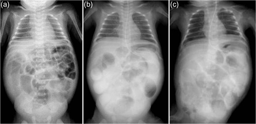 Abdominal radiography. (a) Admission films show partially dilated loops of bowel with intestinal gas (age 20 days). (b and c) Time progression radiography. Five hours after injecting contrast through a gastric tube (b, age 23 days) and 16 h after injecting contrast medium (c, age 24 days); dilated loops of bowel with intestinal gas are visible, with residual contrast medium.