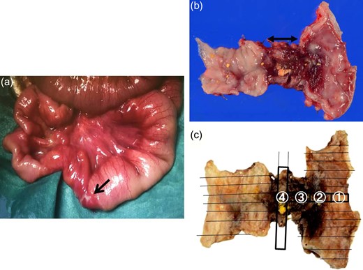 Intraoperative findings, resected specimen and formalin fixation of the specimen with slice. (a) A change in caliber with a stricture in the ileum is visible about 10 cm proximal to the ileocecal valve (black arrow indicates the stricture). (b) In the resected specimen, the lesion is noted to be 1.5 cm in length, featuring a stricture and ulceration. (c) Formalin fixation of the specimen is cut with slices.