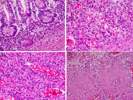 Microscopic pathology. (a) The margins of resection show a few infiltration of eosinophil (×400; ① in Fig. 2c). (b, c) The presence of eosinophil accumulation in the lesions presents more than 20 eosinophils per high-power field (HPF) (b ×400; ② in Fig. 2c, c ×400; ③ in Fig. 2c). (d) In the stenotic portion of the specimen, the layers between the mucosa and the muscularis propria are notably absent, and granulation and fibrotic tissues are found (d ×400; ④ in Fig. 2c).