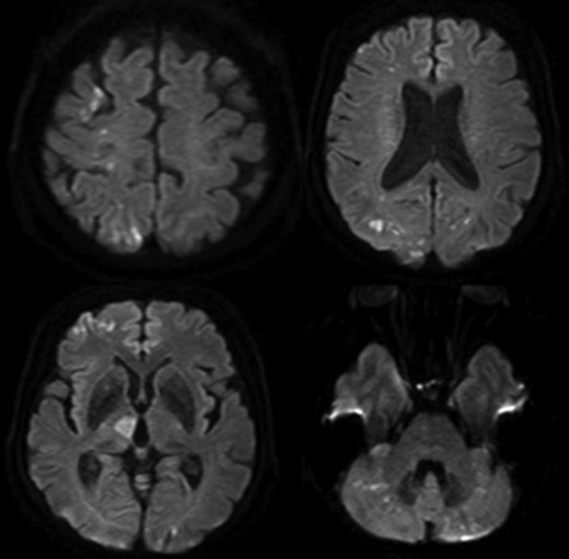 Multiple cerebral infarctions in the right frontal area and cerebellum.