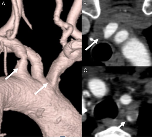 Stenosis in the IA (A, B) and LSA (A, C).