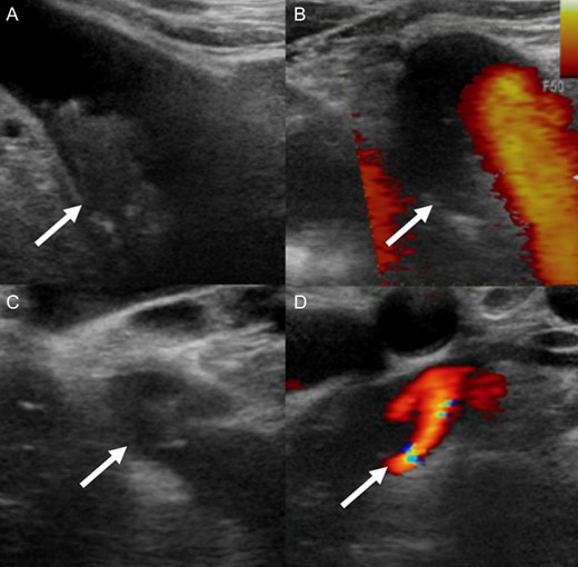 A soft plaque with ulceration in the IA (A, B) and a very mobile soft plaque in the LSA (C, D).