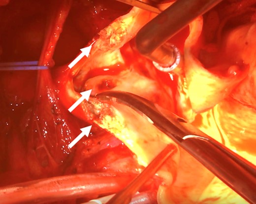 A large plaque in the IA during the operation (arrow).