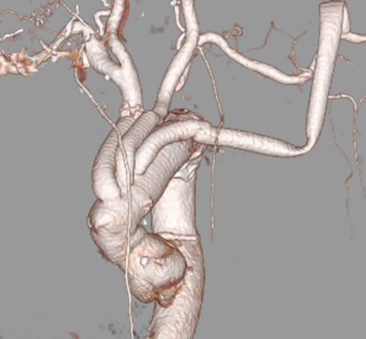 Postoperative CT.