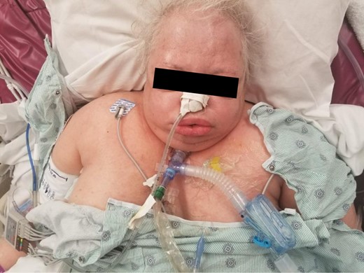 Clinical progression of massive subcutaneous emphysema.