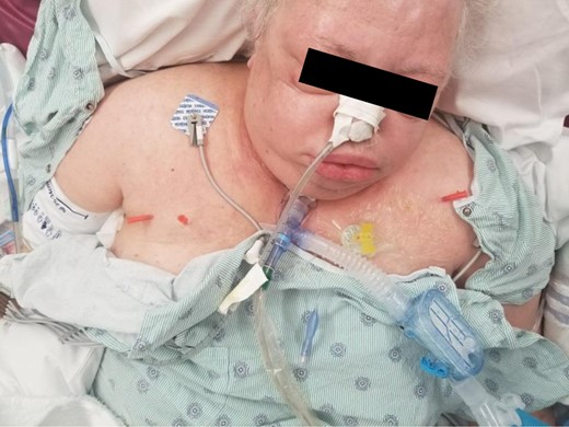 Angiocatheter placement into the right upper lateral chest wall and left upper chest wall.