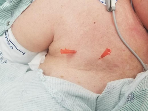 Angiocatheter placement into the deep and oblique fascial layers.