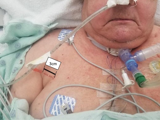 24 hours after placement of angiocatheter demonstrating 3 cm of circumferential decompression from the level of the skin to the proximal hub of the catheter.