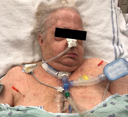 24 h with near-complete resolution of SE.