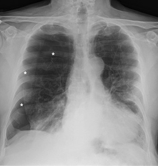 Chest X-ray showing right pneumothorax (asterisk).