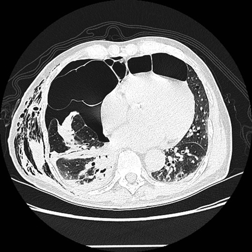 High-resolution computed tomography (HRCT) thorax showing trans‐mediastinal herniation of pulmonary bulla with right pneumothorax.
