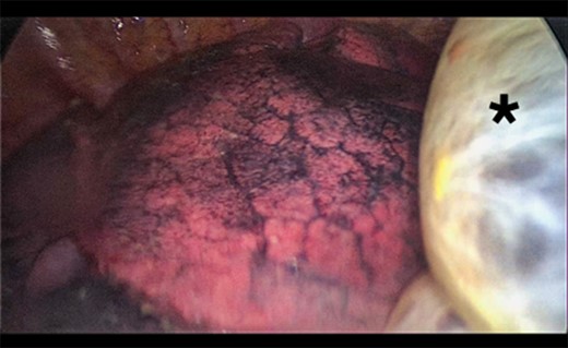 Thoracoscopic view of transmediasinal herniation of pulmonary bulla to the right hemithorax (asterisk).