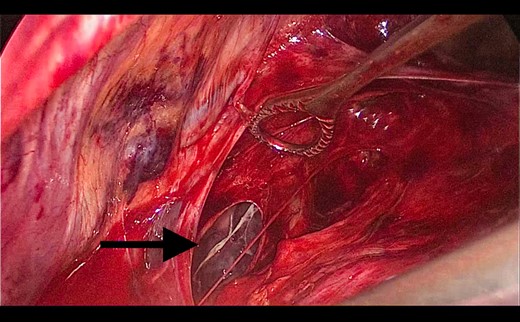 Defect through the mediastinal pleura (arrow).