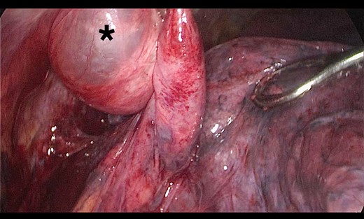Thoracoscopic view from left side of transmediasinal hernia of pulmonary bulla after reduction (asterisk).