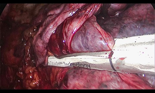Thoracoscopic view from left side of thoracoscopic bullectomy.