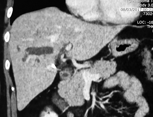 Abdominal computed tomography with stones.