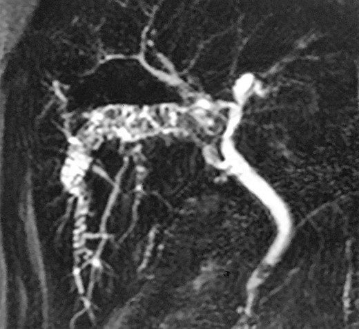 MRCP dilated intrahepatic bile duct with stones.