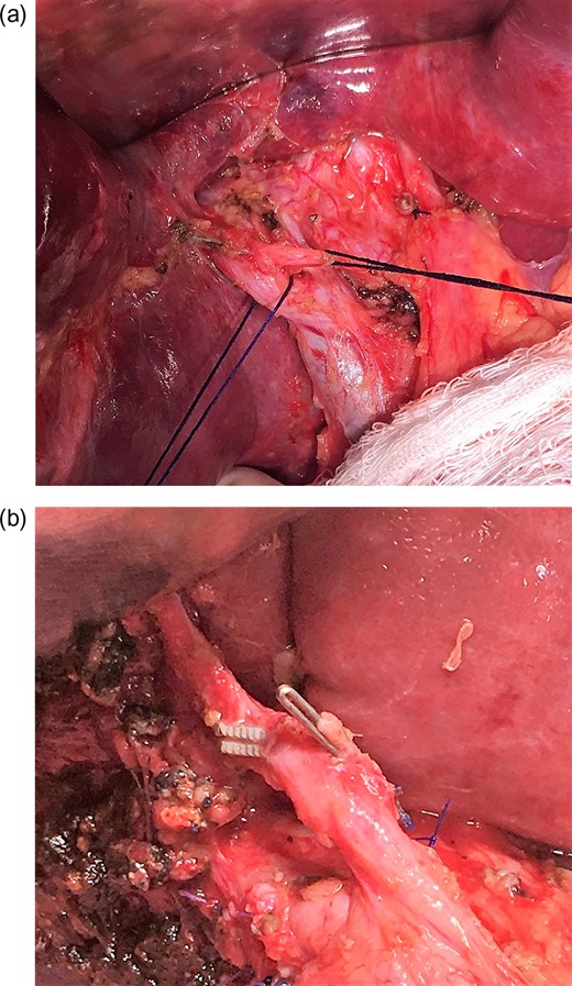 (a and b) Two endoclips identified.