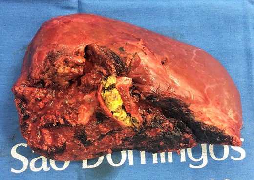 Right hepatectomy (with stones).
