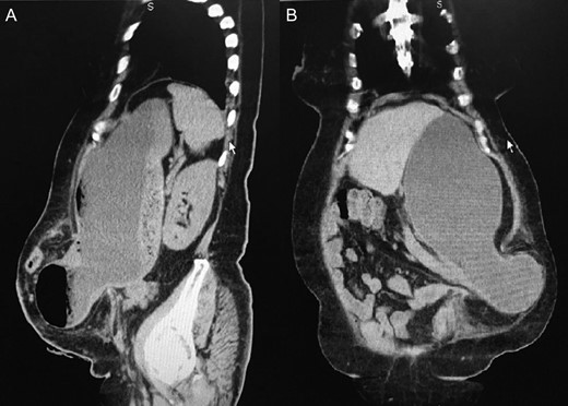 (A) Sagital view of the PH containing the distal part of the stomach. (B) Coronal view of the PH with gastric content in inferior left side of the abdomen.
