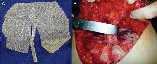 (A) Polypropylene mesh, cut like a letter ‘M’. (B) Final aspect of onlay mesh paraestomal hernioplasty.