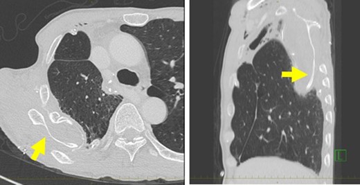 (A) Computed tomography (CT) demonstrating a dislocation of the right scapula in the right thoracic cavity. (B) Sagittal reconstruction of the CT also showed the dislocation of the right scapula.