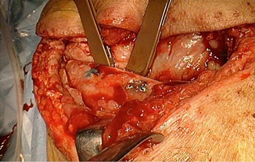 Intraoperative finding. The dislocation of the right scapula with the inferior angle of the scapula protruding into the right intrathoracic cavity though his thoracotomy defect.